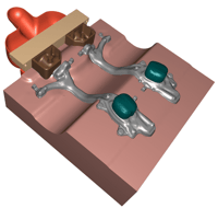 THERCAST_LPDC_simulation