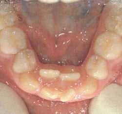 Original condition of the jaw with 2 incisors to be treated