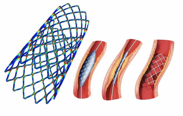 Etude du comportement dynamique d’un stent auto-extensible selon le cycle de pression artérielle (Simulation avec FORGE®)
